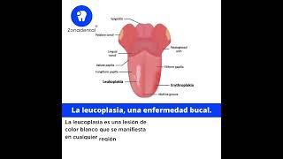 La leucoplasia una enfermedad bucal [upl. by Suiratnod]