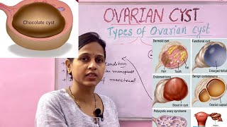 Ovarian cyst Types Endometriomas follicular cyst Corpus leuteum cyst All nursing exams [upl. by Tamsky366]