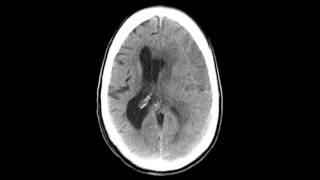 Subdural Hematoma  Before amp After [upl. by Cressler548]