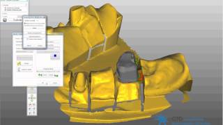 passerelle 3shape exocad telescope [upl. by Nevuer]