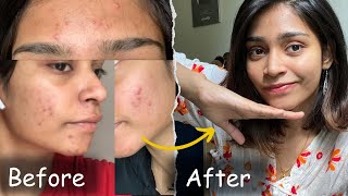 This Changed my life…  No product  No doctor  Acne journey Tamil [upl. by Anaeg]