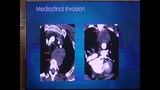 Session 2 Staging of lung cancers [upl. by Johnath612]