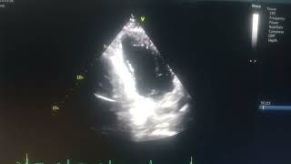 akinetic septum hypokinetic mid apical anterior and inferior wall moderate Lv [upl. by Deirdre825]