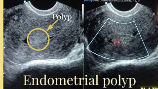 Ultrasound Report of endometrial polyp Sonography of Endometrial masspolyp [upl. by Hescock]