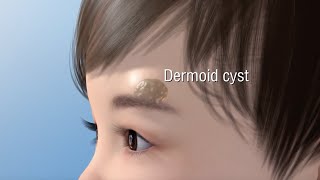 Dermoid Cyst Ablation [upl. by Elson313]