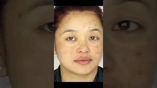 Elosone HT Cream  Benefits and Side Effects  How to Use Elosone HT Cream  Melanin Removal [upl. by Llerrah]