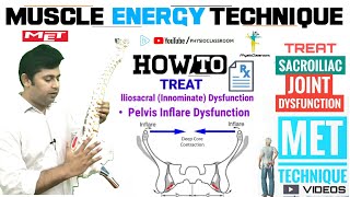 MUSCLE ENERGY TECHNIQUE MET  TREATING INNOMINATE INFLARE DYSFUNCTION SIJ TREATMENT [upl. by Fillander]