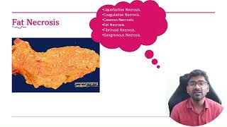 Hypocalcemia in Acute Pancreatitis [upl. by Clerissa]