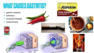 Chronic Gastritis Causes Symptoms Treatment Prevention Why treatment fails and How to fix it [upl. by Atnoed]