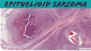 Epithelioid Sarcoma 5Minute Pathology Pearls [upl. by Ingra649]