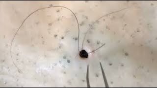 Removal of ingrown hair Watch until the end [upl. by Neehsas645]