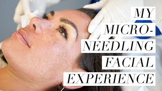 My Microneedling Facial Experience [upl. by Huberty930]