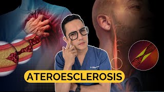 ATEROESCLEROSIS todo lo que debes saber  Dr William Guerrero [upl. by Valonia]