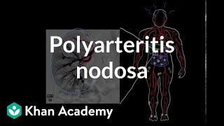 Polyarteritis nodosa  Circulatory System and Disease  NCLEXRN  Khan Academy [upl. by Iclehc]