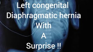 Left congenital diaphragmatic hernia with postoperative pneumoperitoneum [upl. by Arihat]