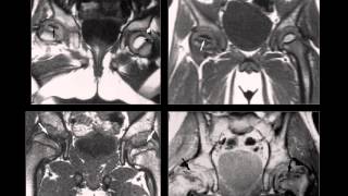 Osteocondrosis Osteocondritis Osteonecrosis Infarto Oseo Radiologia Radiografiaswmv [upl. by Mordecai]