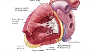 Post MI cardiac rupturepapillary muscle [upl. by Oleic]