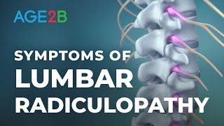 What Are the Symptoms of Lumbar Radiculopathy  Spinal Nerve Root Pain  Disc Bulge [upl. by Munniks603]