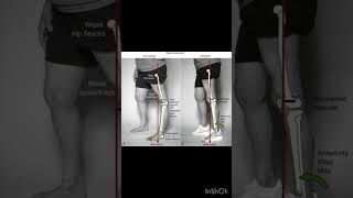 Genu valgum genu varum physiotherapyequipment muscleexercises [upl. by Kcirre]