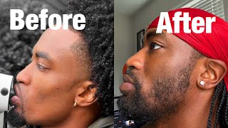 How to Grow a BEARD with a Dermaroller [upl. by Asirahc]