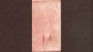 How to Run a Subcuticular Suture  Suturing [upl. by Llechtim]