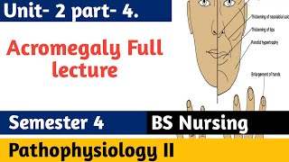 Acromegaly  Growth Hormone Signs amp Symptoms Diagnosis Treatment  Pathophysiology 2 in Urdu [upl. by Akyeluz630]