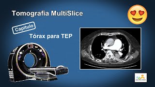 Tomografia Angio de Artérias Pulmonares TEP [upl. by Atiuqiram566]