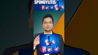 Spondylitis treatment in homeopathy spondyloarthritis  spondin drops uses in hindi spondylitis [upl. by Toddy685]