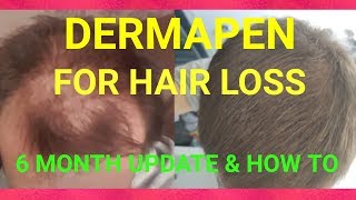 Micro Needling for Hair Loss  How I Use My Derma Pen [upl. by Chaim]