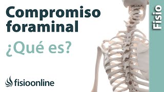 Compromiso foraminal o del neuroforamen  ¿Qué es [upl. by Netsreik]