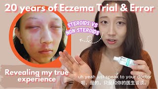 Steroids VS Non Steroid Treatments  Revealing how I healed my Eczema [upl. by Morrison289]