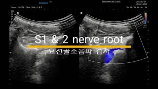 허리 골반 천장관절 통증 S1 and 2 nerve root [upl. by Nikolia820]