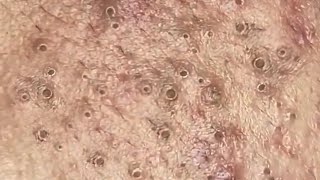 Blackheads amp Whiteheads Satisfying Removal 0077 [upl. by Foah]