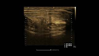 Lipoma  Ultrasound  Case 15 [upl. by Freddi]