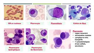 15Gammapathies monoclonales Dysglobulinémies myélome multiple maladie de Waldenström Dr Abbadi [upl. by Madelena]