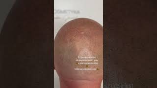 Mikropigmentacja skóry głowy lysine scalpmicropigmentation mikropigmentacja pigmentation barber [upl. by Gnuy]