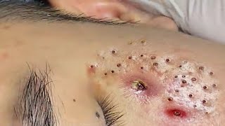 Blackhead Treatment At Loan Nguyen Spa  17 [upl. by Etaner687]