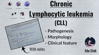 Chronic Lymphocytic LeukemiaCLL  Small lymphocytic lymphomaSLL  Pathology [upl. by Acirej]