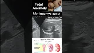 Fetal Meningomyelocele Insights into Diagnosis and Care case fetalanomaly shorts DrSaimakhan [upl. by Dnalor531]