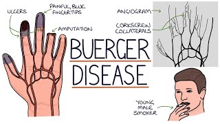 Understanding Buerger Disease Thromboangiitis Obliterans [upl. by Earaj]