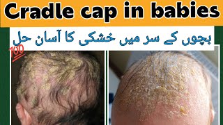 How to remove cradle cap dandruff easily  Cradle cap dandruff treatment at home [upl. by Enaelem]