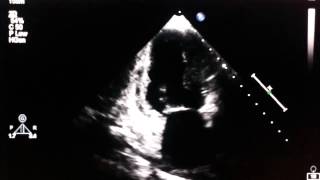 Echocardiogram  akinesia of the inferior wall [upl. by Eitsirc44]