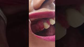 Gingival hyperplasia bleedinggums [upl. by Annoet839]