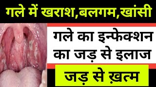 Sore Throat Infection In HindiThroat Infectionगले में खराश होनागले में दर्दकारण लक्षण एवं उपाय [upl. by Alliuqet]