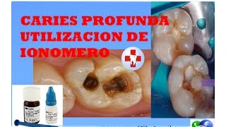 CARIES PROFUNDA Y IONOMEROS [upl. by Aneliram]