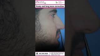 कैसे होते हैं लम्बे और मोटे नाक को सही किया जा सकता है  nose correction longnose [upl. by Lanuk]