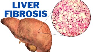 Liver Fibrosis  What are the symptoms of liver fibrosis  247nht [upl. by Ahsrav]