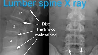 Easy way to X ray Lumbosacral spine  X ray spine  radiology sign [upl. by Jeanette]