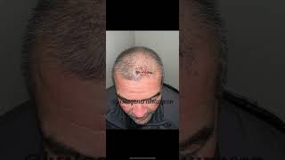 Inside the OR with justageneralsurgeon  before amp after photos of this huge scalp mass How is it [upl. by Codding]