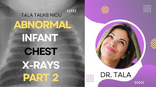 Neonatal CXRs made easy CDH Effusions Pneumothorax [upl. by Erek]